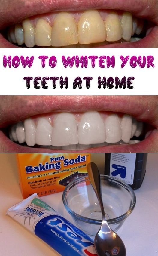 Easy Home Remedy for Teeth Whitening at Home. 